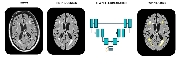 Original MRI scan, pre-processed MRI scan, diagram of segmentation process, and the brain scan with WMH highlighted in yellow